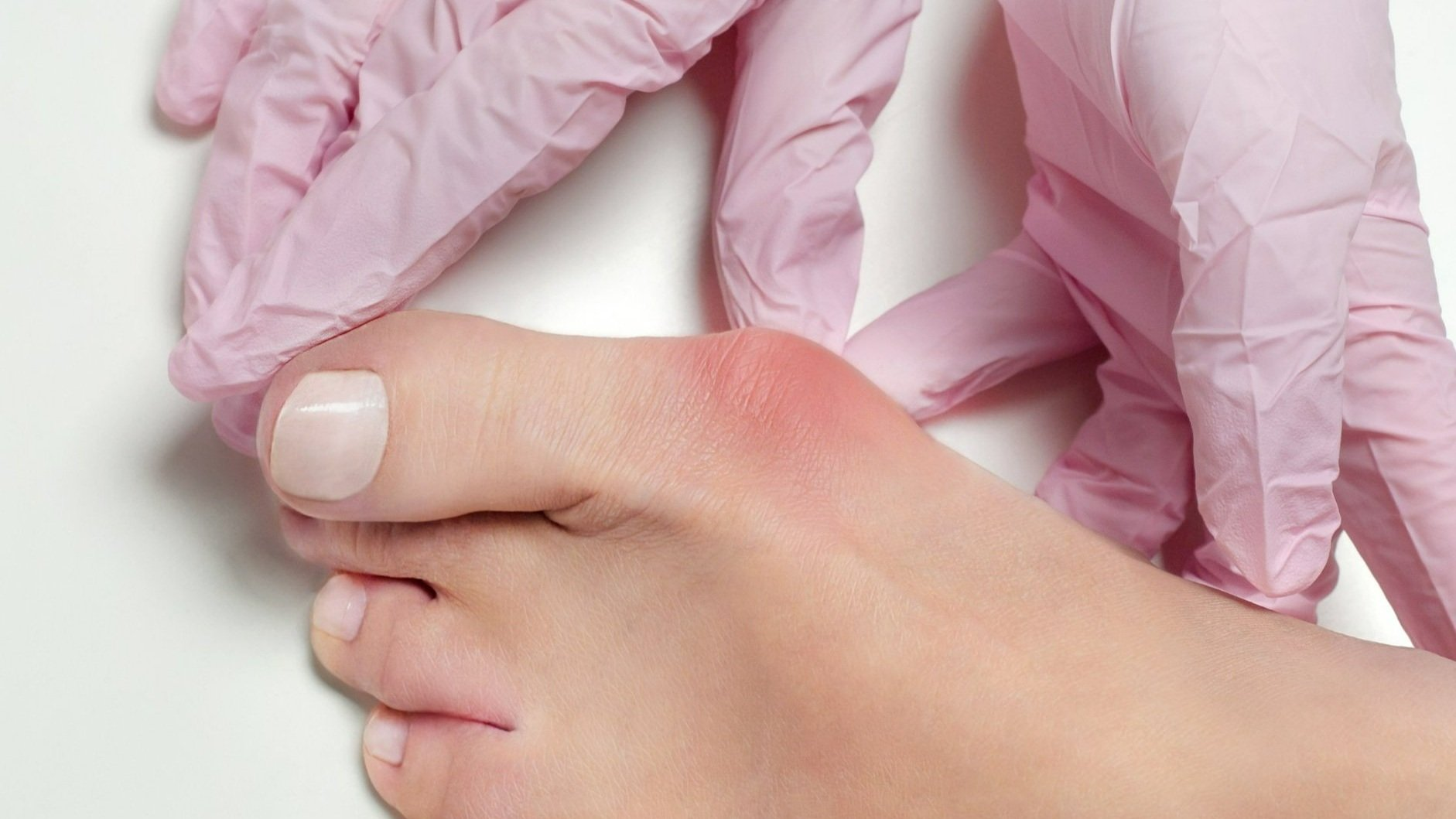 foot with sore bunion