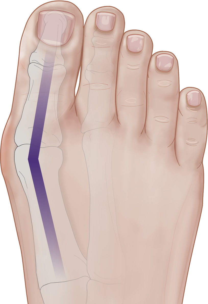 mild bunion image