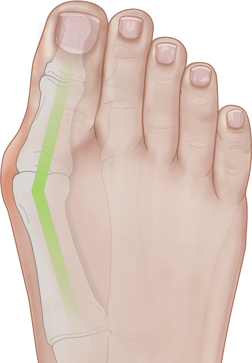 moderate bunion image