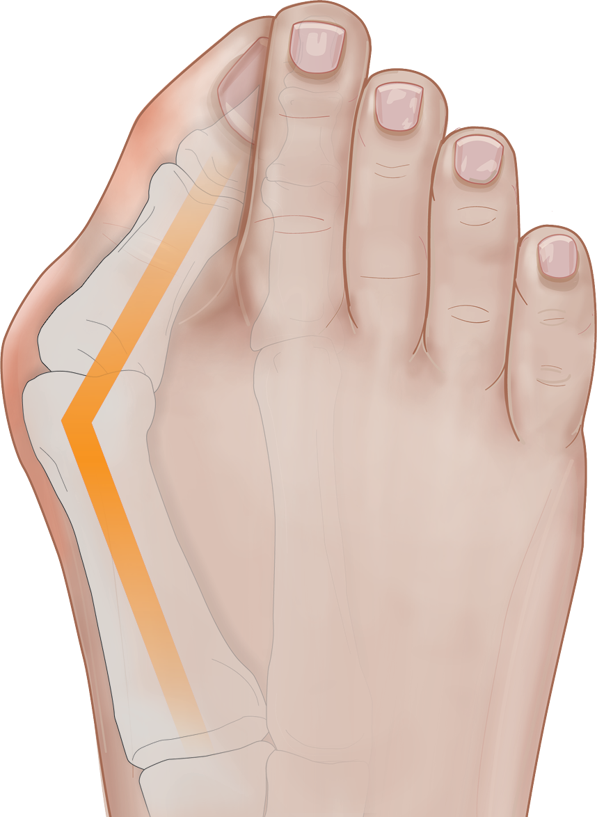 severe bunion image
