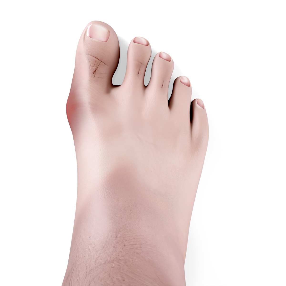 Mild Bunion Image