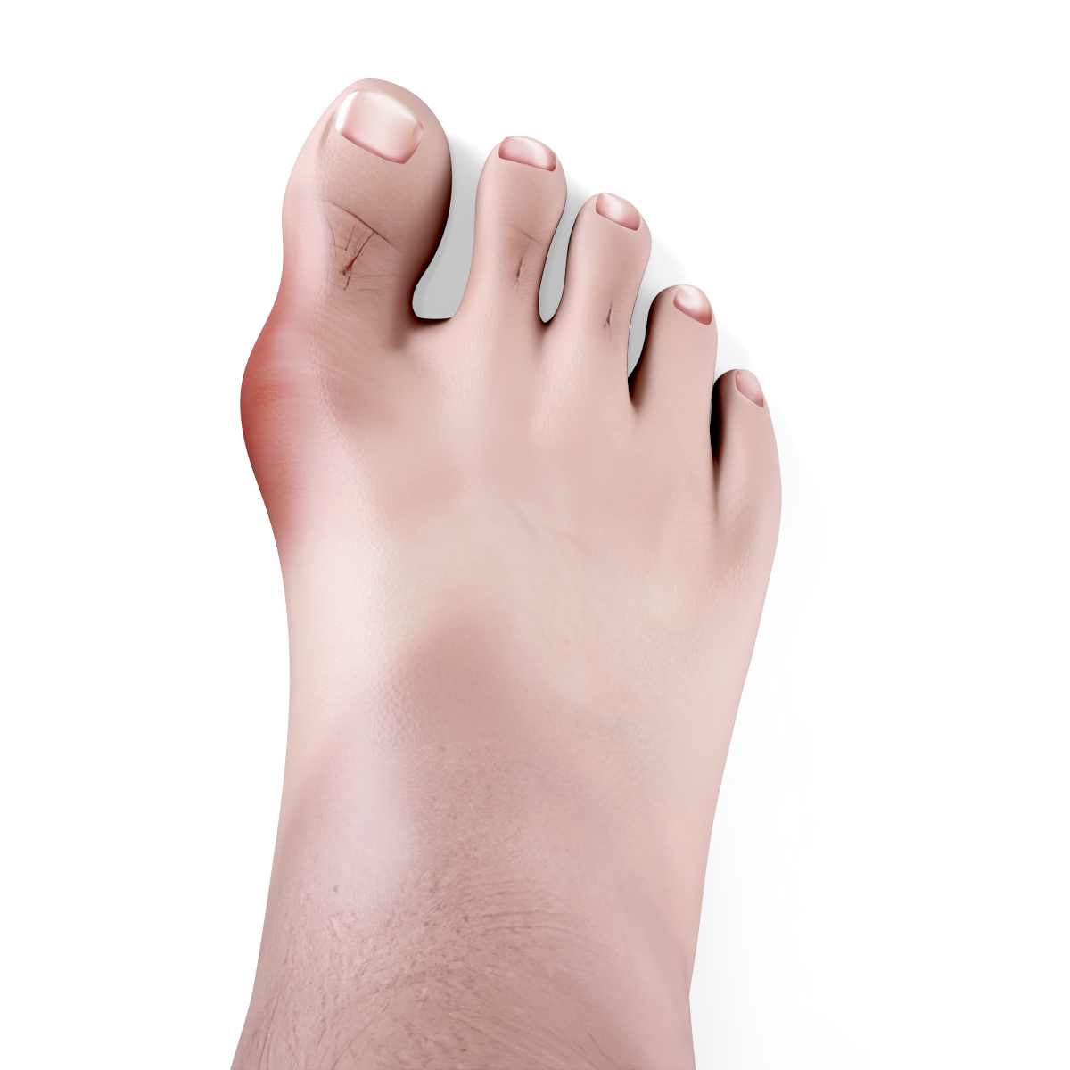 Moderate Bunion Image
