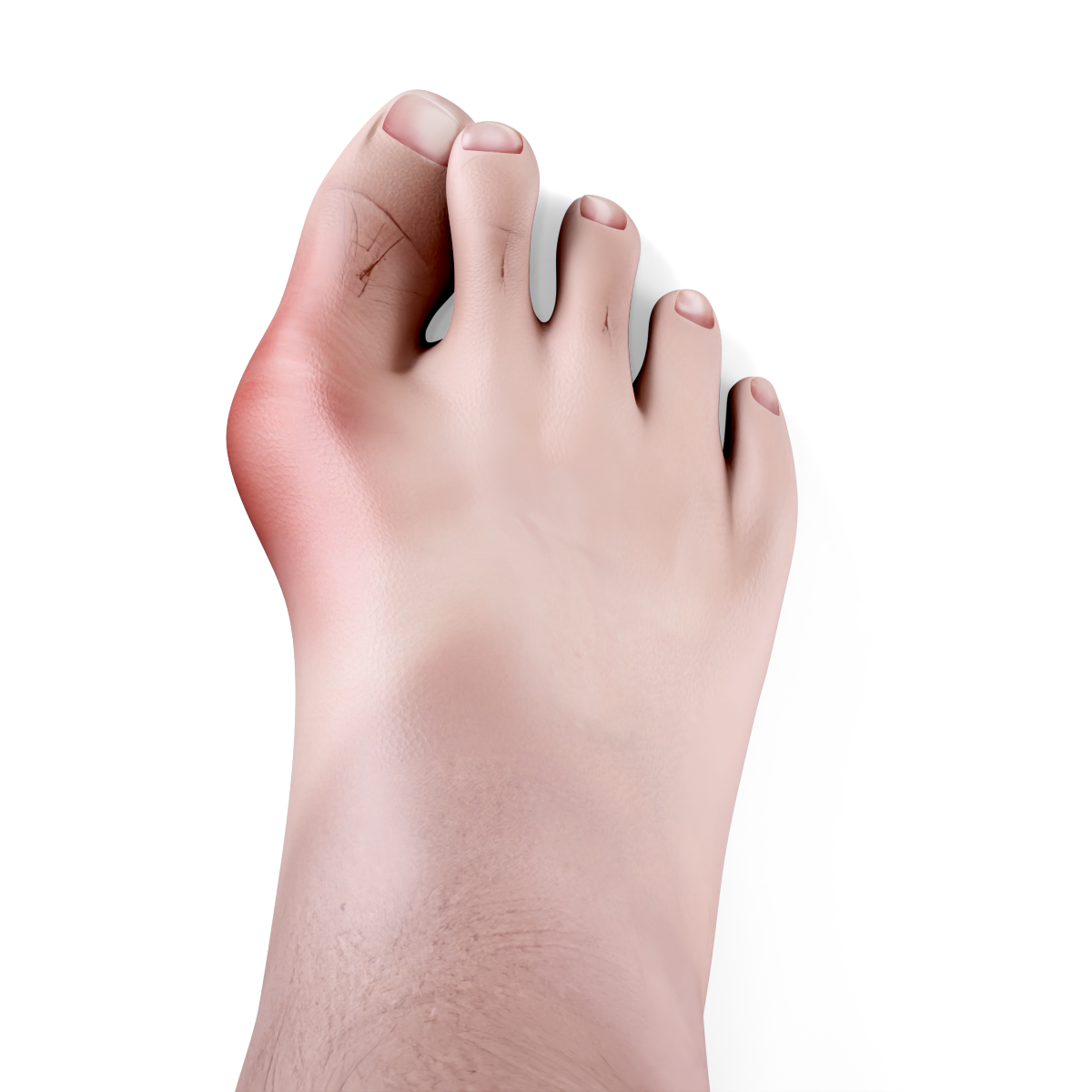 Severe Bunion Image