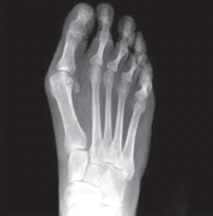 bunion xray